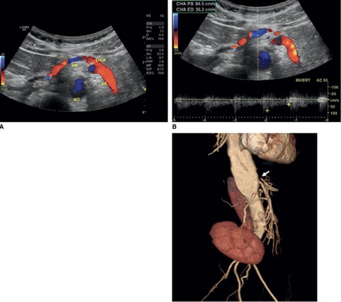 <p>Due to celiac artery occlusion</p><p>Blood flows towards splenic artery - RABT color pattern</p>