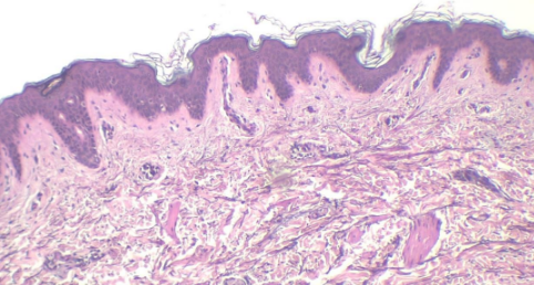 <p>Which one: <strong>Basal Cell Carcinoma</strong> OR <strong>Normal Epithelium</strong></p>