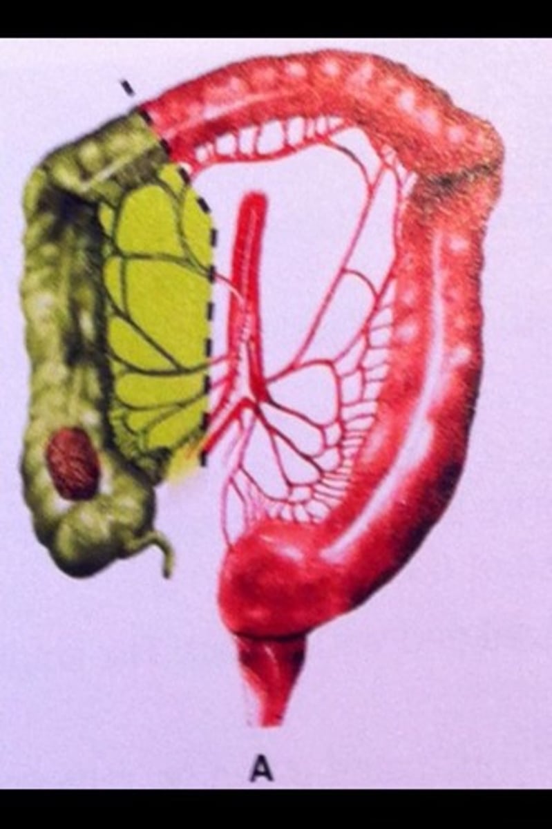 <p>Excision of the colon</p>