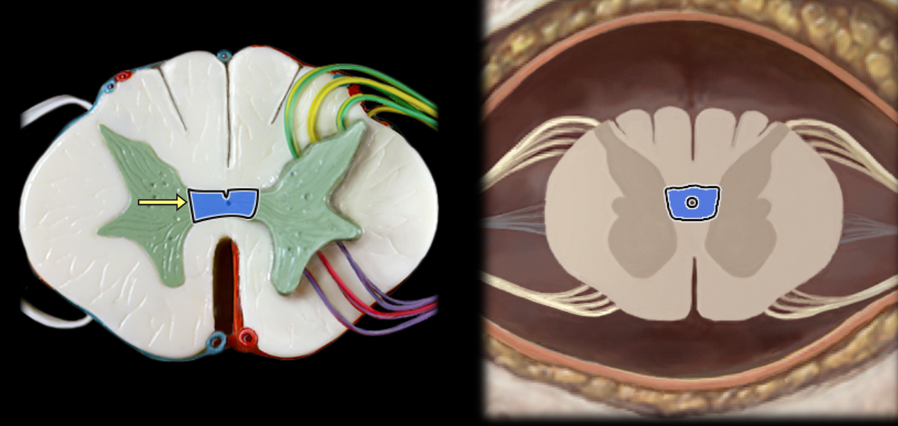 <p>Gray commissure</p>