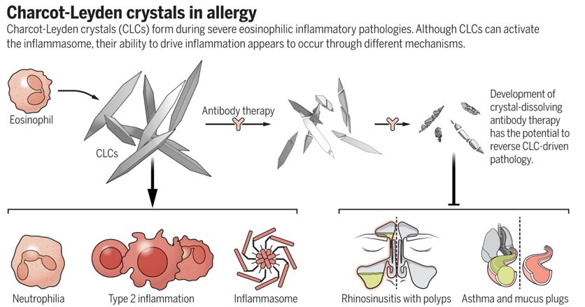 <p>Eosinophil-derived crystals found in severe <strong>eosinophilic inflammation</strong>, such as in chronic allergic rhinitis, asthma, and nasal polyps. They<strong> drive inflammation</strong> and may be reduced with antibody therapy.</p><p><em>Key feature of </em><strong><em>SEVERE </em></strong><em>asthma &amp; chronic rhinitis w/nasal polyps</em></p>