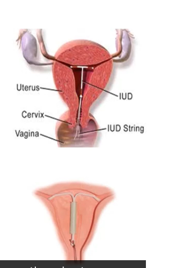 <p><span>Copper IUCDs create a toxic, inflammatory intrauterine environment that is hostile to sperm and implantation. They work without hormones.</span></p><p></p><p><span><strong>Step-by-step</strong></span></p><p><span>Copper ion release</span></p><ul><li><p><span>The device continuously releases Cu²⁺ ions into the uterine cavity.</span></p></li></ul><p></p><ol><li><p><span>Direct spermicidal effect (primary mechanism)</span></p><ul><li><p><span>Copper ions:</span></p><ul><li><p><span>Are toxic to sperm</span></p></li><li><p><span>Reduce sperm motility and viability</span></p></li><li><p><span>Increase reactive oxygen species</span></p></li></ul></li></ul></li></ol><p></p><ul><li><p><span>Fertilisation is usually prevented before sperm reach the egg.</span></p></li></ul><p></p><ol start="2"><li><p><span>Sterile inflammatory reaction</span></p></li></ol><ul><li><p><span>Copper acts as a foreign body → local inflammatory response</span></p></li><li><p><span>↑ Leukocytes, macrophages, and prostaglandins</span></p></li><li><p><span>This environment is hostile to:</span></p><ul><li><p><span>Sperm</span></p></li><li><p><span>Eggs</span></p></li><li><p><span>Early embryos</span></p></li></ul></li></ul><p></p><p><span>Endometrial effects</span></p><ul><li><p><span>Prostaglandins + inflammation → endometrium unsuitable for implantation</span></p></li><li><p><span>Also causes:</span></p><ul><li><p><span>↑ uterine contractility</span></p></li><li><p><span>↓ implantation probability</span></p></li></ul></li></ul><p></p><ol start="3"><li><p><span>Mechanical contribution</span></p></li></ol><ul><li><p><span>Physical presence of the device adds a minor mechanical barrier, but this is not the main effect</span></p></li></ul><p></p><p><span><strong>Important clarifications (exam-relevant)</strong></span></p><ul><li><p><span>Copper IUCDs do not disrupt an established pregnancy</span></p></li><li><p><span>Main action is pre-fertilisation</span></p></li><li><p><span>Can be used as emergency contraception (up to 5 days post-intercourse)</span></p></li><li><p><span>No systemic hormonal effects</span></p></li></ul><p></p><p></p>