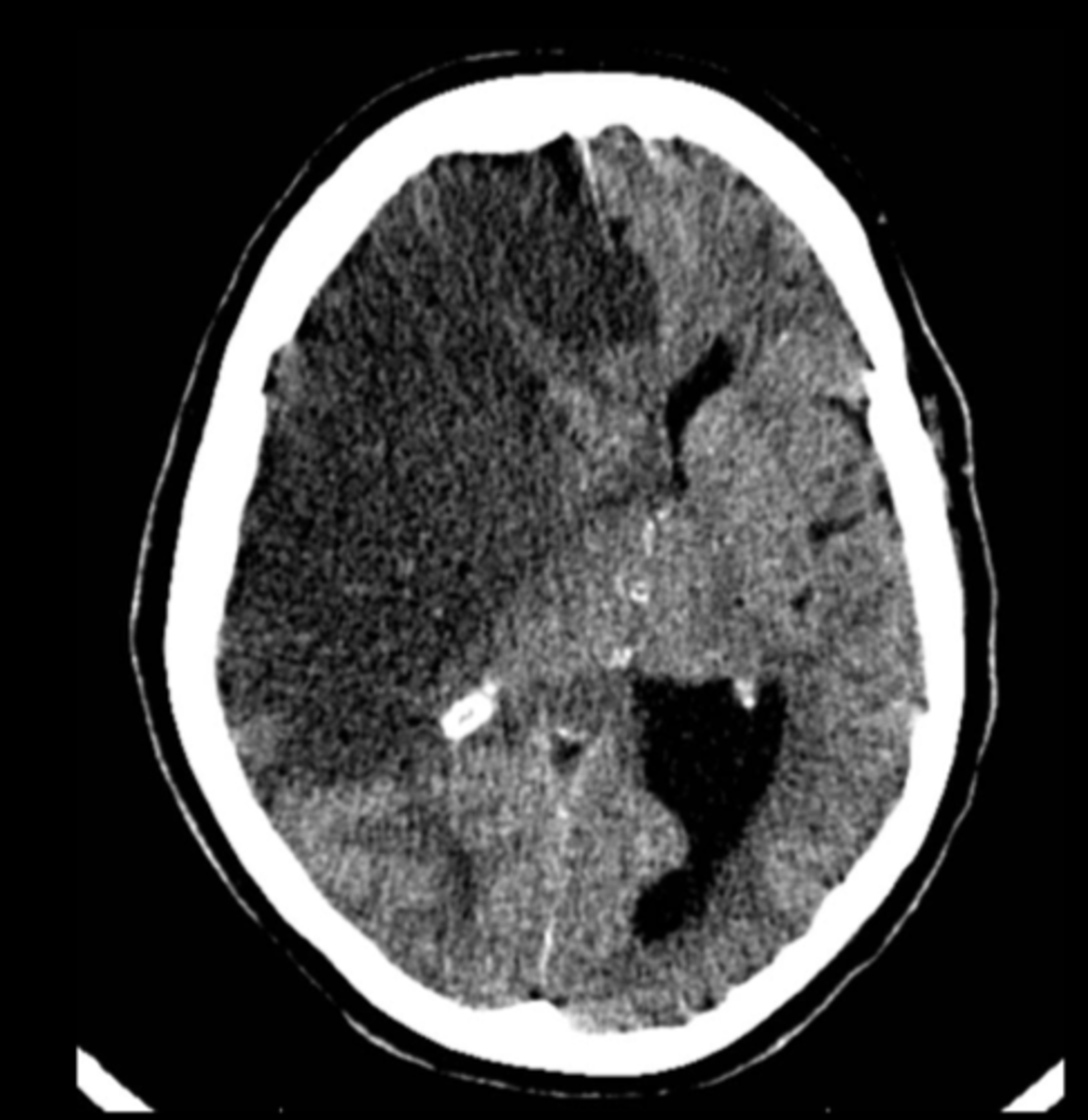 <p>Primary symptom from this specific stroke would be leg weakness for example, so what artery did this stroke manifest?</p>