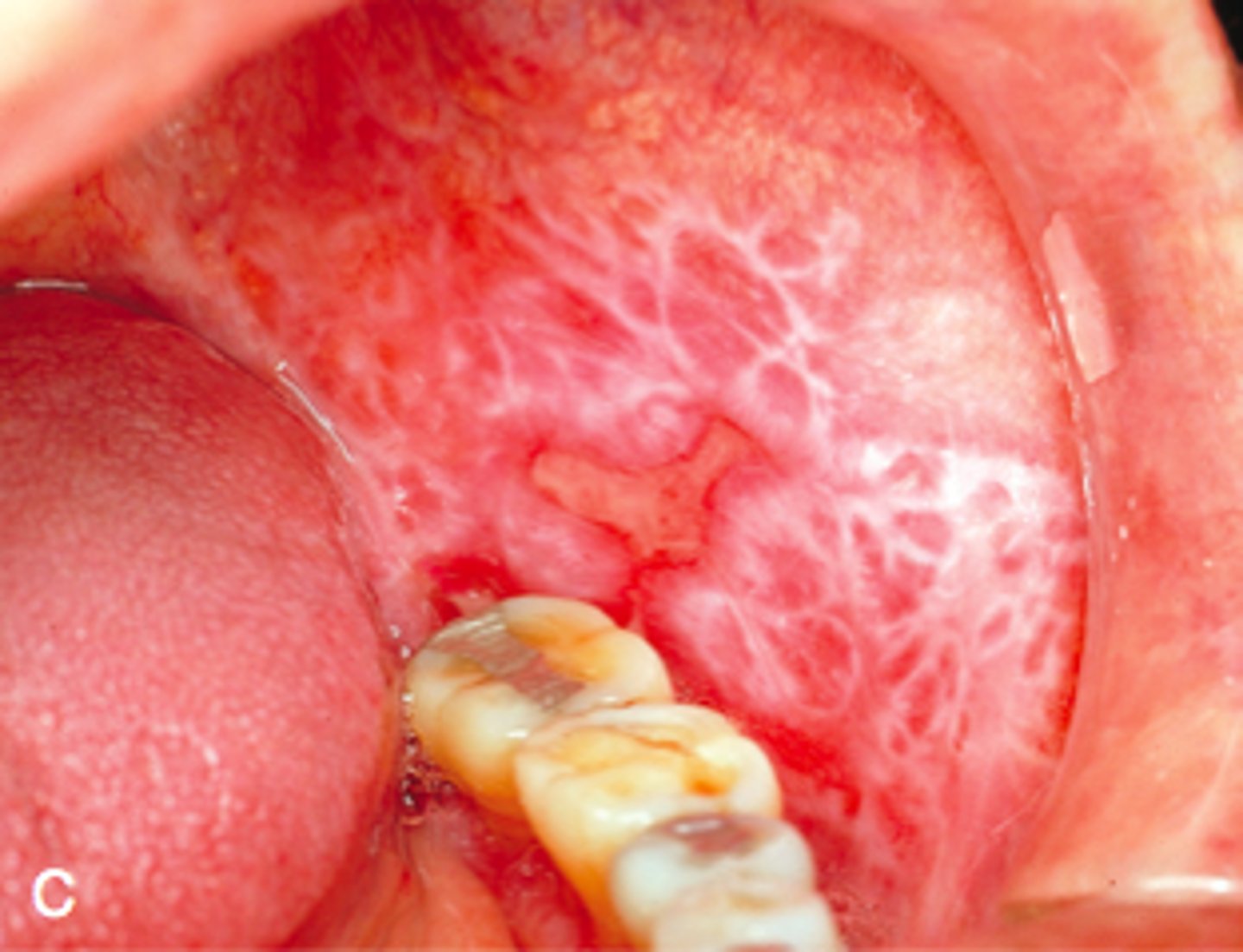 <p>Lichen planus</p>
