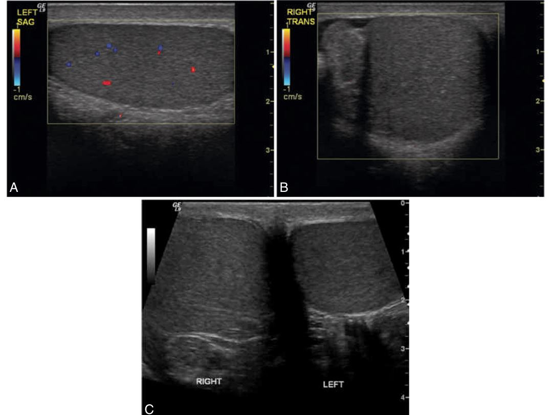 <p><strong>Testicular __________ in  an adolescent patient with sudden onset of right testicular pain, accompanied by nausea and vomiting.</strong></p><p> (A) Color Doppler shows normal flow within the parenchyma of the left testis. </p><p>(B) The right testis and epididymis are avascular with color Doppler imaging, with the same settings used to show flow on the asymptomatic side. </p><p>(C) Transverse ultrasound image showing both testes in right testicular torsion. The right testis is swollen and hyperechoic compared with the normal left testis.</p>