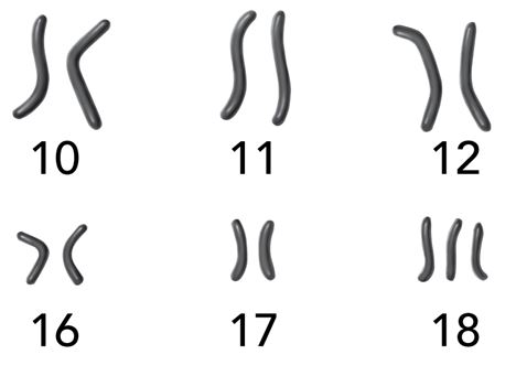 <p>The karyotype supports the following explanation of events. During the process of gamete formation in the (male/female/male or female) parent of the patient, one pair of chromosomes failed to (elongate/replicate/uncoil/separate) during a stage of (mitosis/meiosis/DNA replication).</p>