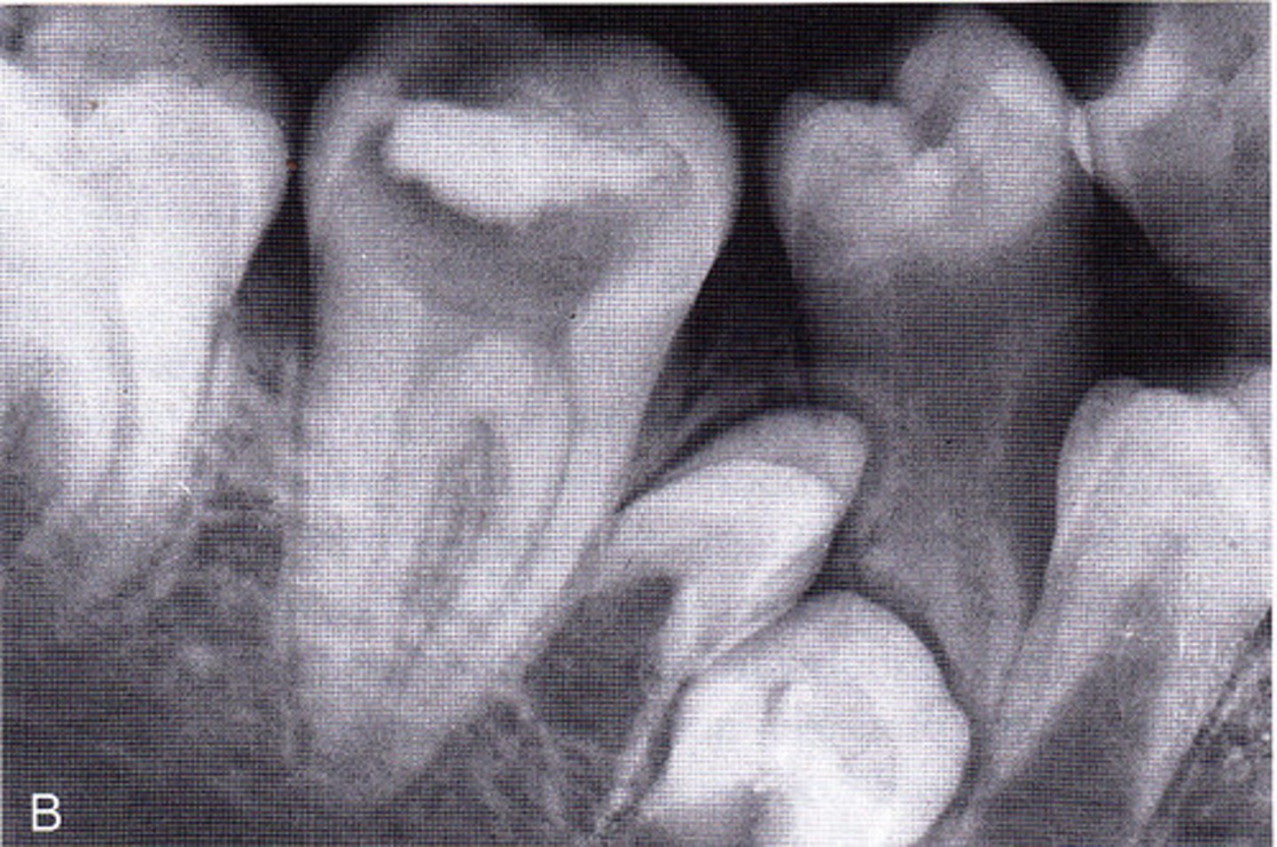 <p>Excess number of teeth</p>