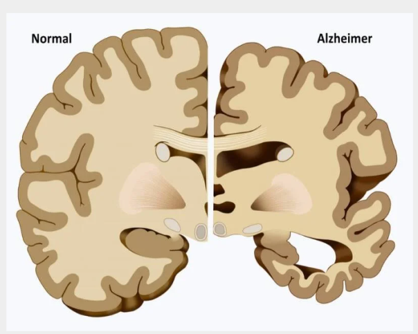 <p>Dementie (problemen met geheugen en denken).</p><p>Fout bij de acetylcholine neurotransmitters.</p>