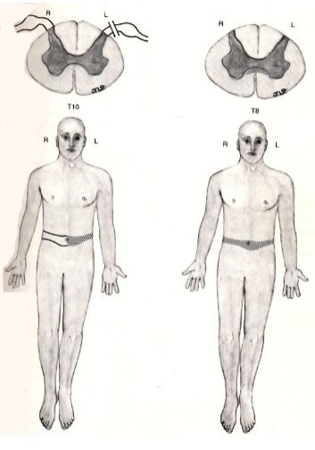 <p>caused by lesions that do not involve the long tracts and therefore they reveal a band-like distribution of deficit</p>