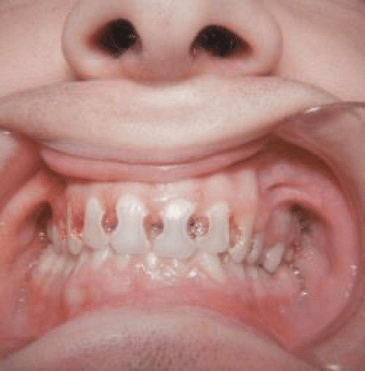 <p>Begins in smooth surfaces where there are no pits, grooves, biofilm collects proximal surfaces, cerical 1/3, harder to clean areas</p>