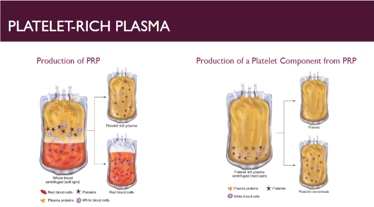 <ul><li><p><span>Donations maintained at RT during all stages of collection, storage, and production</span></p></li><li><p><span>Platelet-rich plasma (PRP) method</span></p><ul><li><p><span>Produces a single platelet component from single WB donation, random-donor platelets (RDPs)</span></p></li><li><p><u><span>Contains a minimum of </span></u><strong><u><span>5.5 x 10</span><sup><span>10</span></sup></u></strong><u><span> platelets</span></u></p></li><li><p><span>Total volume 40-70 mL</span></p></li><li><p><span>Residual RBCs cannot exceed 1.0 x 10</span><sup><span>9</span></sup><span> RBCs per component</span></p></li><li><p><strong><u><span>One therapeutic dose for adult equivalent to 4-6 PRP platelets, each prepared from one WB donation</span></u></strong></p></li></ul></li></ul><p></p>