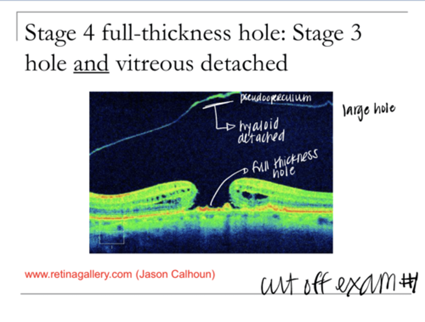 <p>Describe Stage 4 Macular Hole</p>