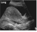 <p>Where is the Pouch of Douglas?</p><p>*common spot for blood to accumulate in F</p>