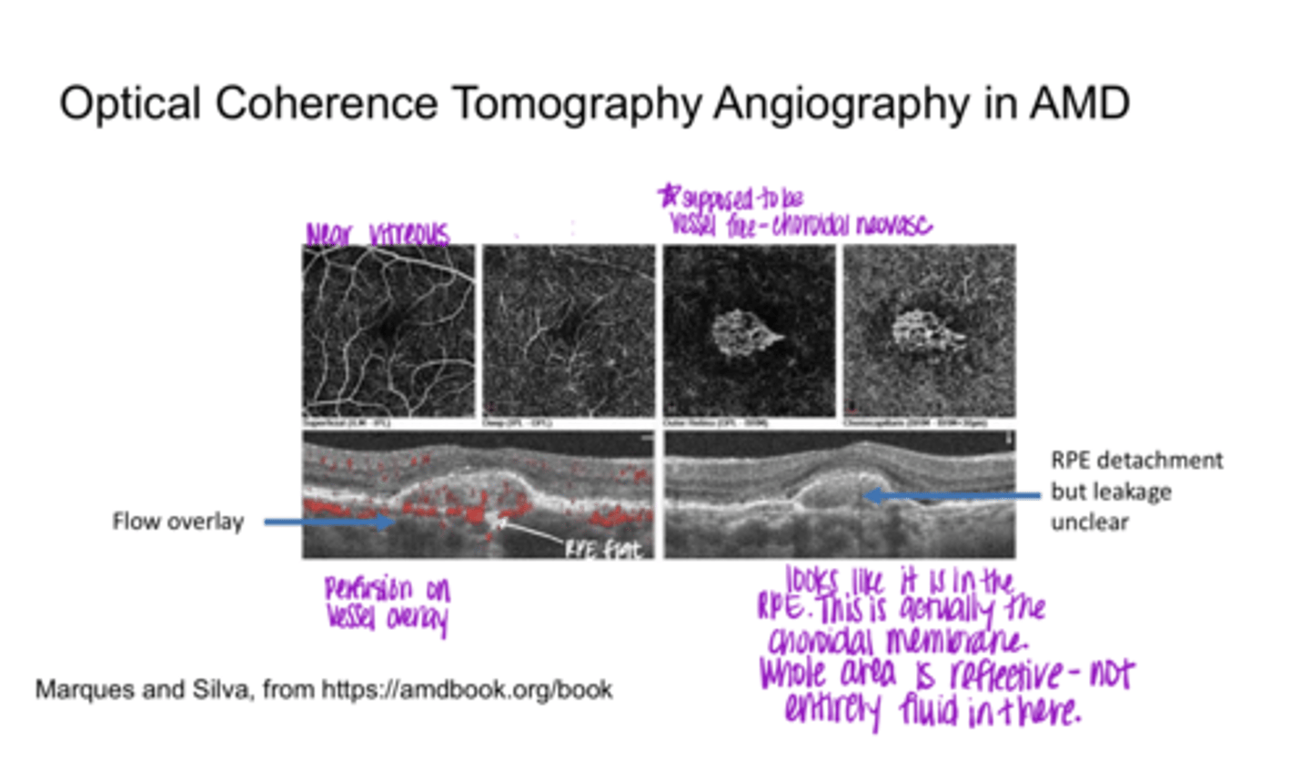 <p>What are you looking for on OCT-A with AMD?</p>