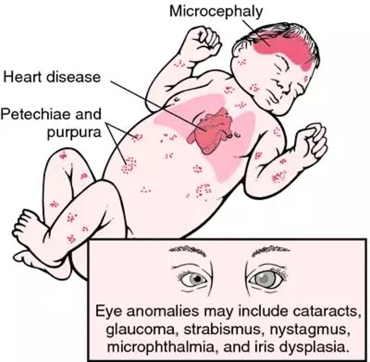 <p>1. Pregnant women contracted Rubella virus</p><p>2. Infants with fetal damage, deafness, heart defects, mental retardation in 35% of cases</p><p>3. 15% mortality within first year of life</p>