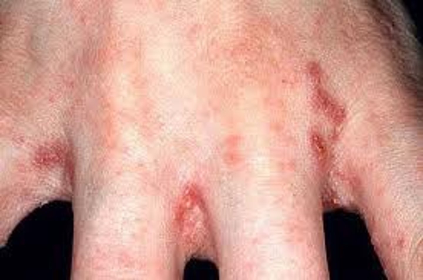 <p>n /ˈskeɪ.biːz/ bệnh ghẻ Scabies is a contagious skin condition caused by tiny mites.</p>