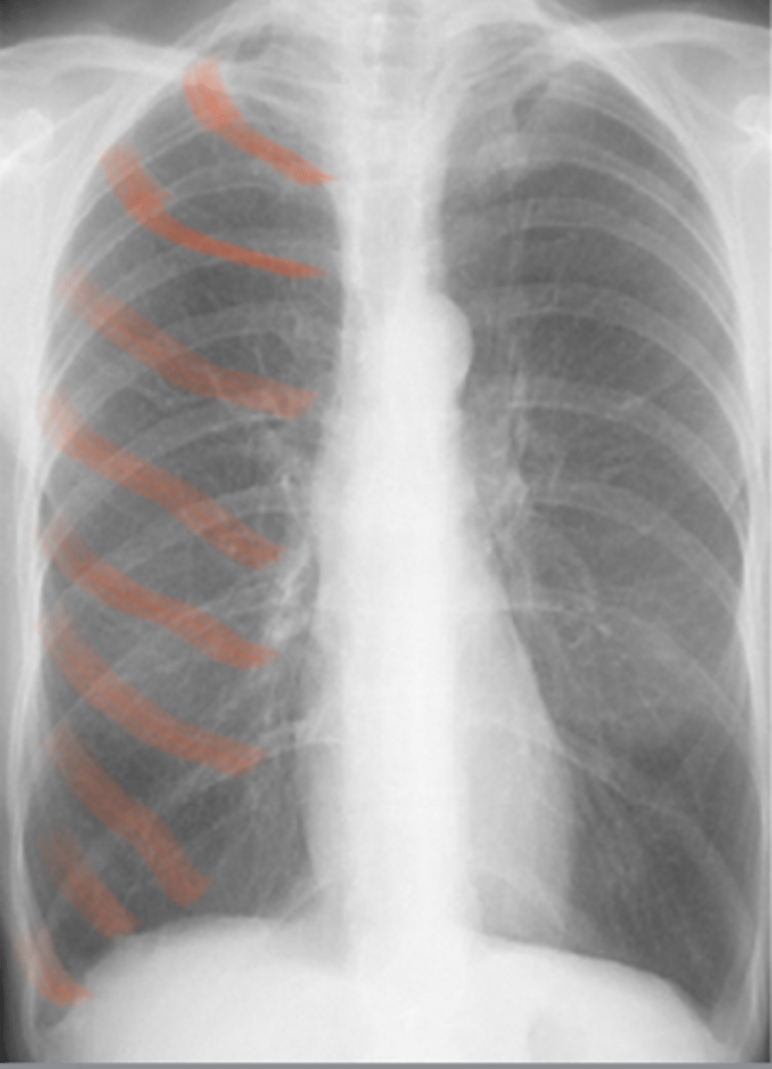 <p>COPD = emphysema/ chronic bronchitis CXR features: Hyperinflation more than 6 anterior ribs/ 8 posterior visible Flattening of hemidiaphragm</p>