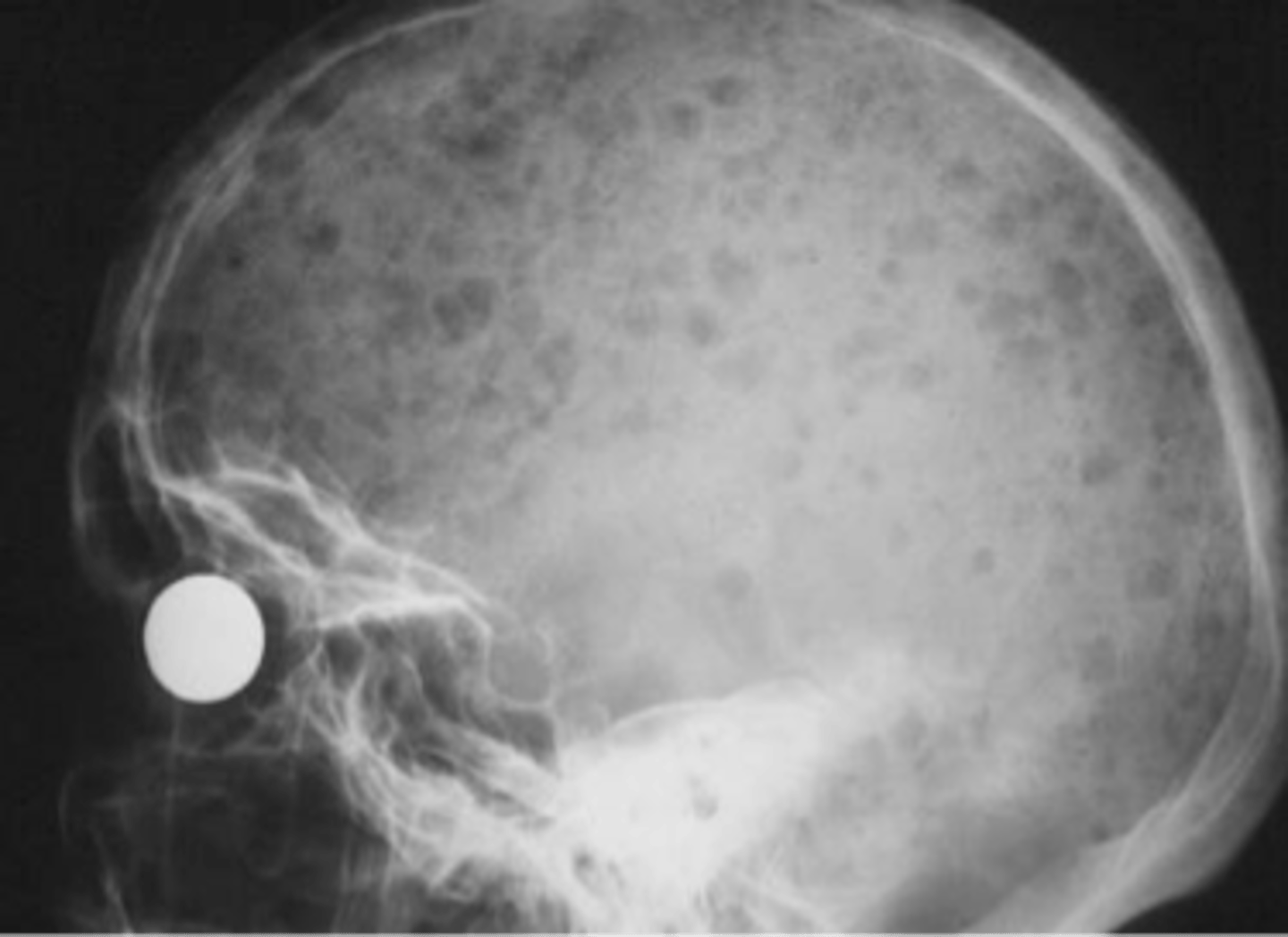 <p>ID imaging finding of multiple myeloma</p>