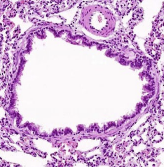 <p><strong><u>Different from bronchus:</u></strong></p><ul><li><p>Has <span style="color: rgb(0, 109, 255)"><strong>only smooth muscle</strong></span></p></li><li><p><span style="color: rgb(0, 109, 255)"><strong>No cartilage</strong></span></p></li></ul><p><strong><u>Epithelium:</u> </strong><span style="color: rgb(0, 109, 255)"><strong>Simple cuboidal ciliated </strong></span>epithelium</p><p><strong><u>Which cells decrease:</u></strong></p><ul><li><p><span style="color: rgb(0, 109, 255)"><strong>Goblet cells</strong></span></p></li><li><p><span style="color: rgb(0, 109, 255)"><strong>Basal cells</strong></span></p></li></ul><p><strong><u>Which cells increase:</u> </strong><span style="color: rgb(0, 109, 255)"><strong>Clara cells</strong></span></p><p><strong><u>Lamina propria:</u></strong></p><ul><li><p><strong><u>Are there glands:</u> </strong><span style="color: rgb(0, 109, 255)"><strong>No</strong></span><strong> </strong>(<em>glandless connective tissue</em>)</p></li><li><p><strong><u>What is present:</u> </strong><span style="color: rgb(0, 109, 255)"><strong>Smooth muscle</strong></span></p></li></ul><p><strong><u>What occurs to the adventitia:</u></strong></p><ul><li><p><span style="color: rgb(0, 109, 255)"><strong>No cartilage</strong></span></p></li><li><p>But <span style="color: rgb(0, 109, 255)"><strong>extensive</strong></span><strong> </strong>network of<span style="color: rgb(0, 109, 255)"> <strong>elastic fibers </strong></span>around <span style="color: rgb(0, 109, 255)"><strong>smooth muscle </strong></span>layers</p></li></ul><p></p>