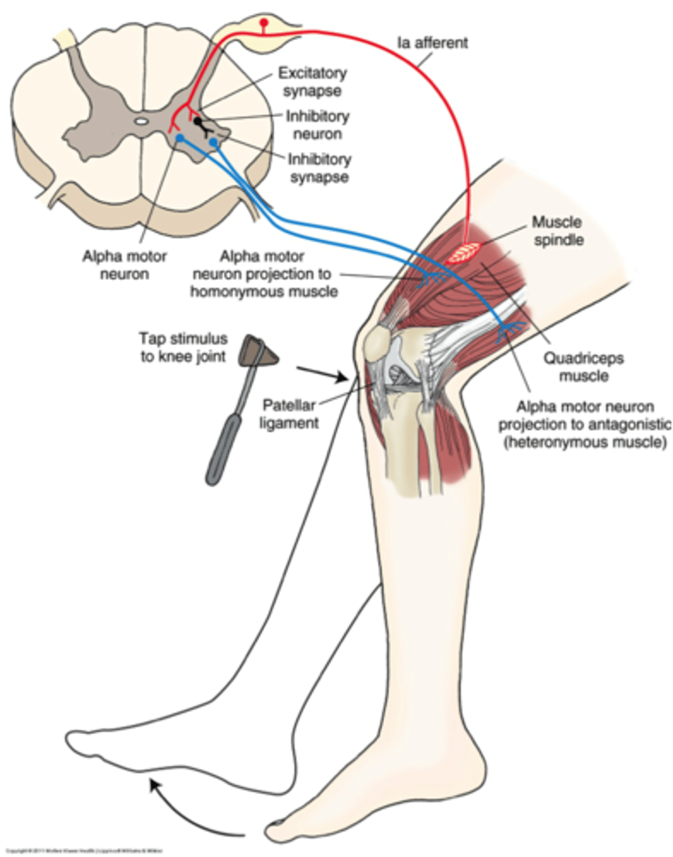 <p>- also called "tendon tap"or "knee jerk"</p><p>- monosynaptic reflex (no interneuron)</p><p>"big wings" = ventral side</p><p>ventral = motor side</p><p>dorsal side = sensory</p><p>muscle spindle = coil like, bc its wrapped around something</p><p>sensory neuron = 1a afferent =</p><p>tap tendon = stretches nerve = sensory neuron fires = singal travels up peripheral nerve = enters dorsal = through dorsal horn = monosynaptic synapses with alpha neuron = releases gluatamate (excitation - depolarixation or motor neuron) = excited motor neuron = travels back down = contraction</p><p>***monosynaptic is like a negative feedback</p><p>pseudounipolar neuron (cell body in the middle)</p><p>neuron root: visible structure that projects from the spinal cord (dorsal root)</p><p>- it has swelling - which is called a dorsal root ganglion (ganglion = cluster of cell bodies)</p><p>ventral root and dorsal root connect together just outside spinal cord - called a spinal nerve root (sensory and motor component coming together), you'd have a right spinal nerve and a left from each vertebrae (ie. L4 for quadracieps) come together as "mixed nerves" or "peripheral nerves" (ie. femoral nerve)</p><p>reciprocial inhibition:</p><p>in order to contract the muscle, you bave to relax the opposite muscle :</p><p>branch -&gt; inhibitory neuron; hyperpolarizes its target (also alpha motor neuron), this motor neuron travels through different mixed nerve, goes to antagonist muscle (hamstrings) = inhibits nerve of hamstring (sciatic) = relax</p>