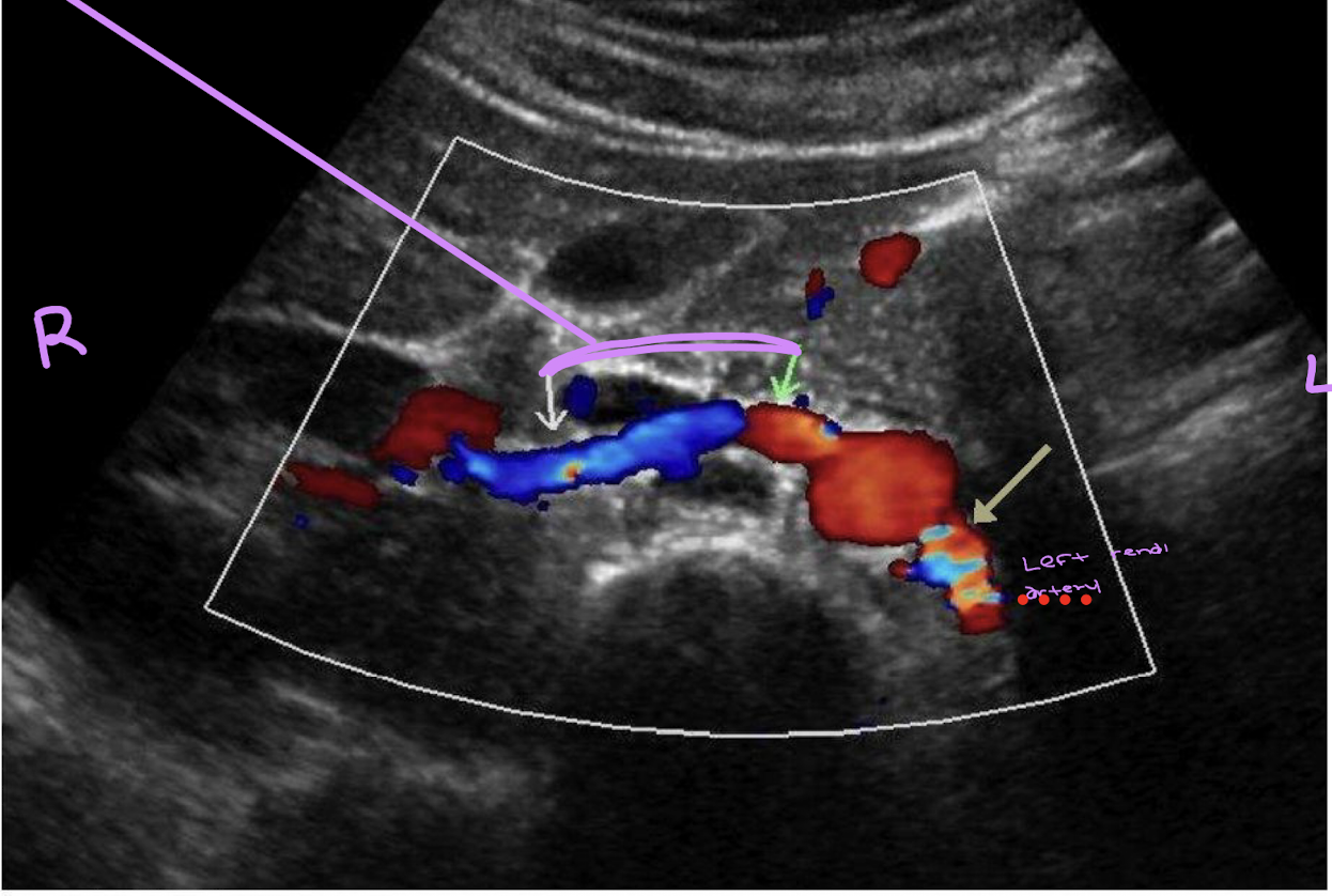 <p>keep in mind the right renal artery is positioned at 10:00 and the left is at 4:00</p>