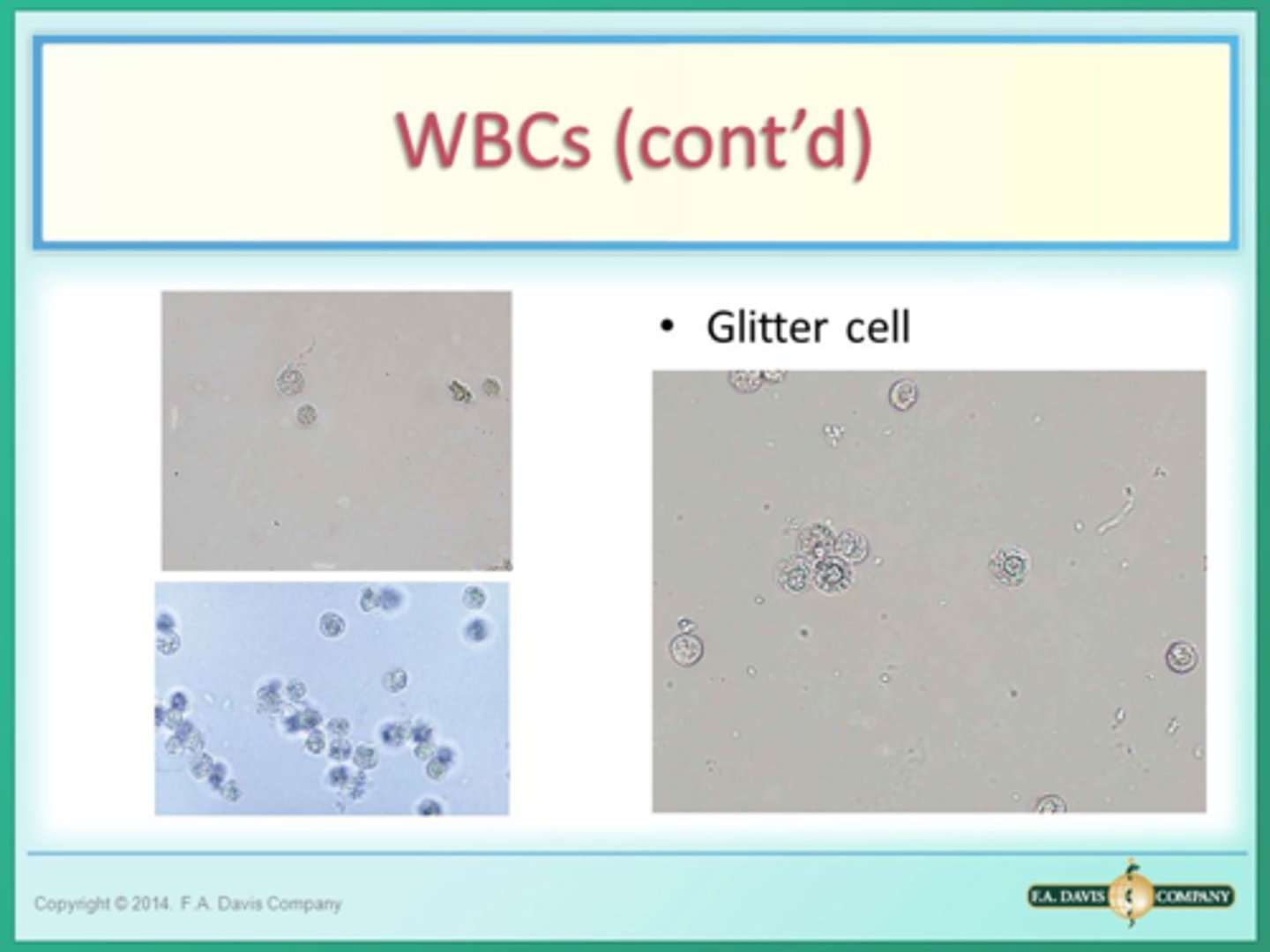 <p>WBC and Glitter Cells</p>