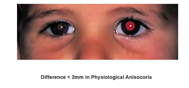 <p>unequal pupil size in normal room illumination </p><p>down to physiology </p>