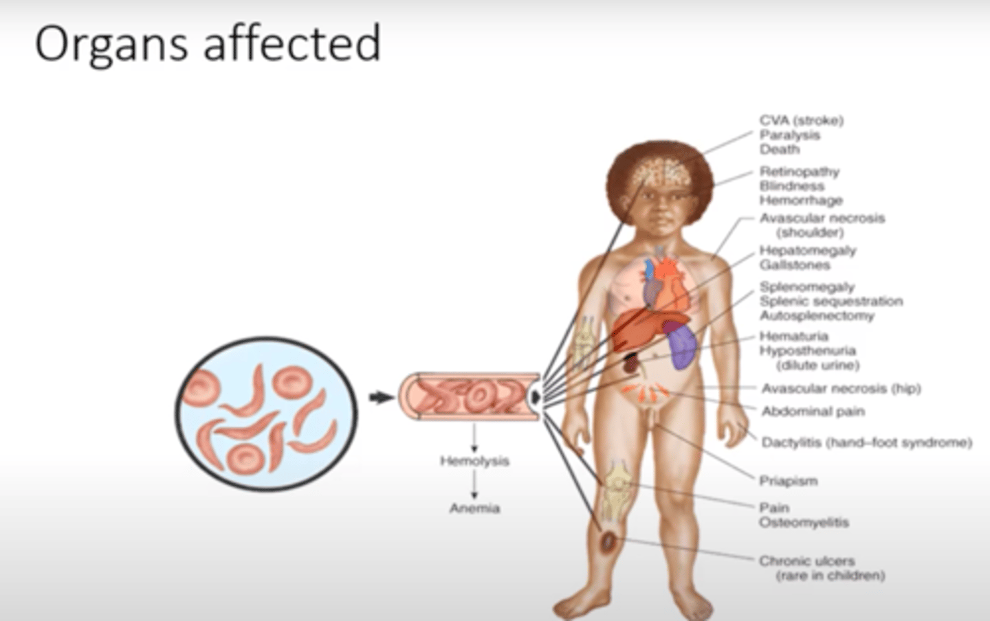 <p>assessment &amp; physical findings</p><p>assessment of diet (vitamin c, sources of iron)</p><p>prepare child and family for laboratory tests</p><p>decreased oxygen demands (rest)</p><p>prevent complications</p><p>anticipatory guidance and educations</p><p>-iron rich foods/supplements</p><p>support family</p><p>teach about iron fortified formula and cereals</p><p>-iron supplements if breastfeeding</p><p>-if mom is anemia, tendency is that the infant will be as well</p>