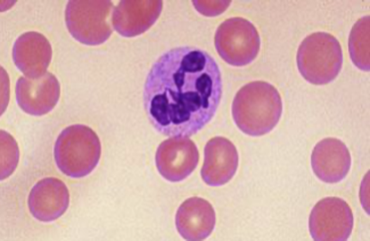 <p>neutrophils with MORE than 6 segments</p><ul><li><p>commonly seen in </p><ul><li><p><strong>megaloblastic anemias </strong>(B12 and folate deficiencies)</p></li></ul></li></ul><p></p>
