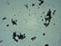 <p>Name this ACIDIC crystal that resembles sand in an old urine? What is it associated with? Normal or abnormal?</p>