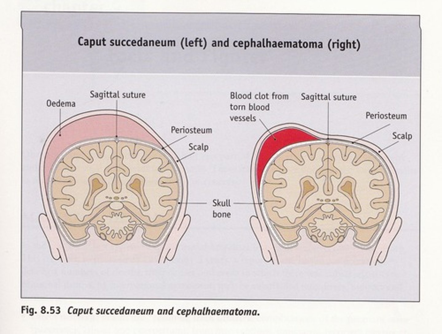 <p>Caput succedaneum</p><p>Cephalohematoma does NOT cross the suture line</p>