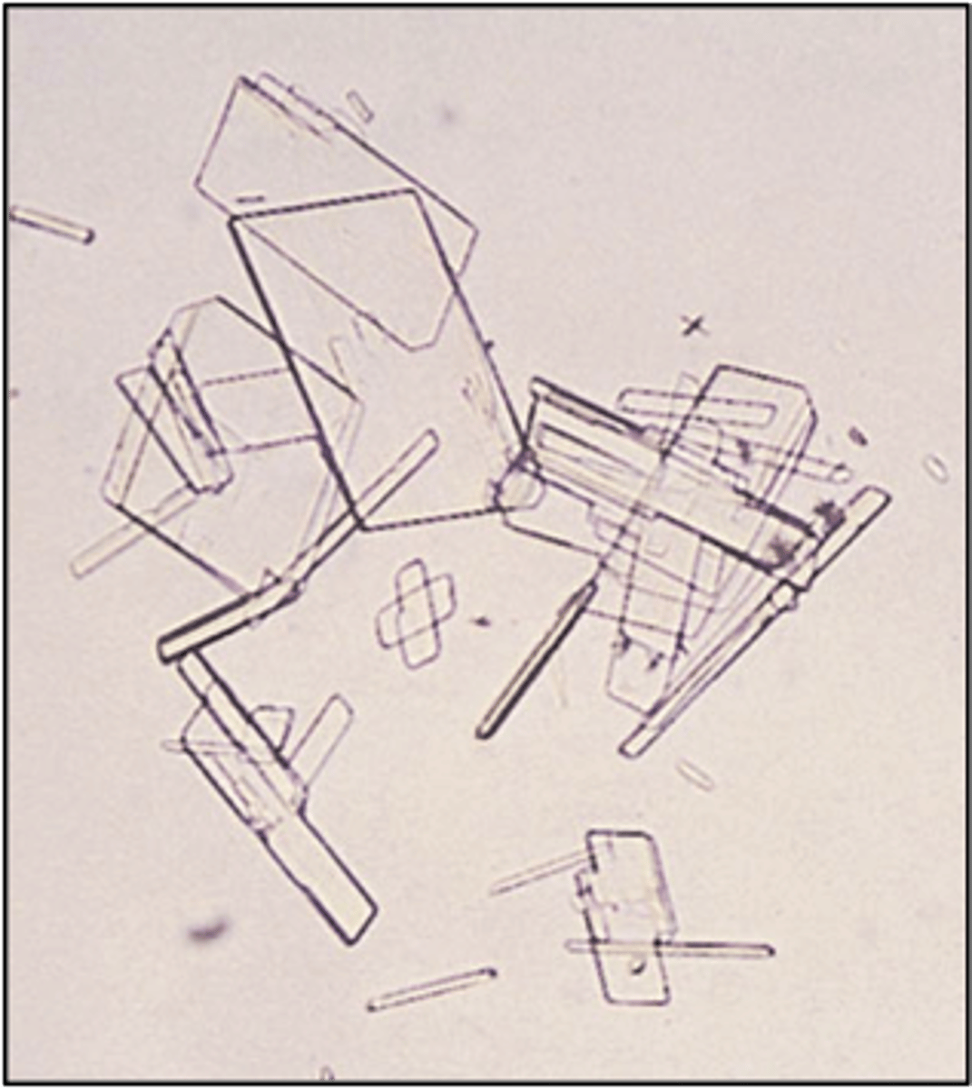 <p>-Abnormal= rarely seen unless specimen is refrigerated. Seen with fatty casts and oval fat bodies. Highly birefringent</p><p>-pH= Acid</p><p>-color/form= colorless (notched plates)</p><p>-Disorders= Nephrotic syndrome</p>