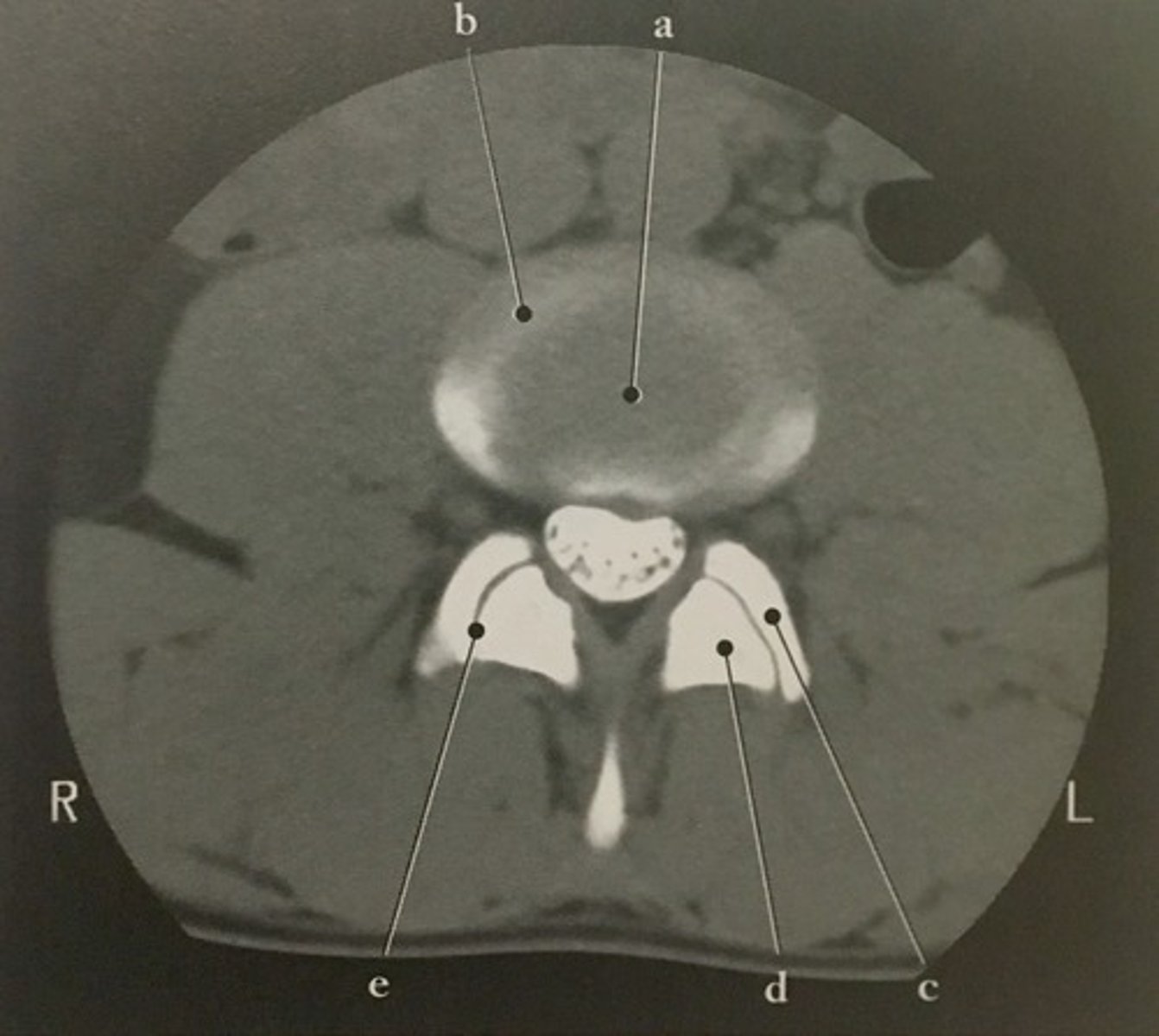 <p>Identify structure C on this axial CT slice of the lumbar spine with intervertebral disk.</p>