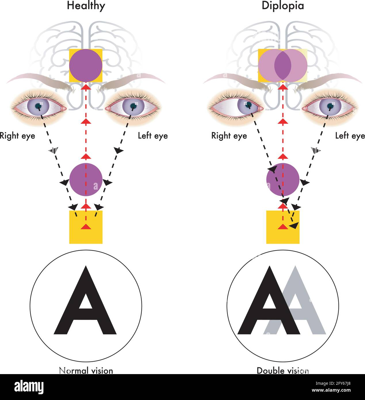 <p>term. diplopia </p>