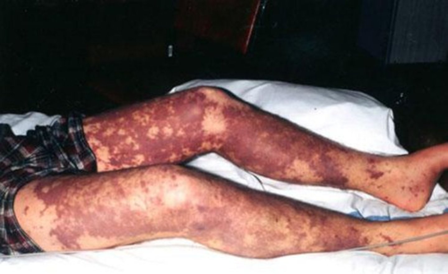<p>- Fever</p><p>- Headache</p><p>- Nausea/vomiting</p><p>- Petechial rash</p>
