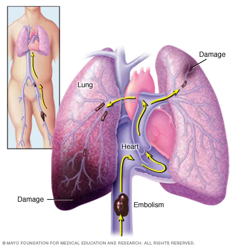 <p>A condition which <span>occurs when a clump of material, most often a blood clot, gets stuck in an artery in the lungs, blocking the flow of blood. The portions of lung served by each blocked artery can't get blood and may die. Causing a pulmonary infarction.</span></p>