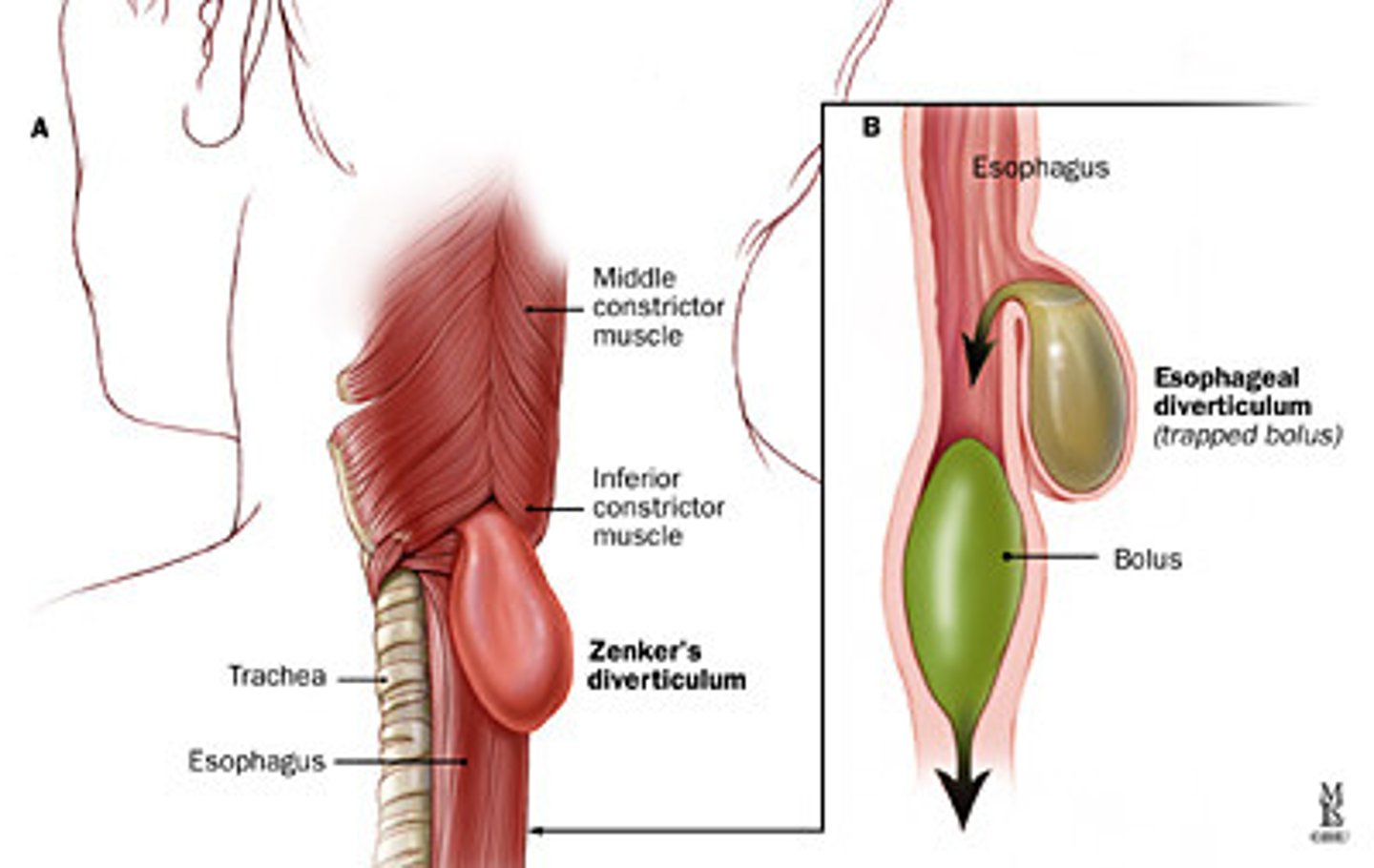 <p>Food gets stuck in esophagus causing a pouch</p><p>- halitosis (bad breath)</p><p>- sour taste</p><p>- dysphagia</p><p>- neck fullness</p><p>- regurgitation</p><p>- belching</p>