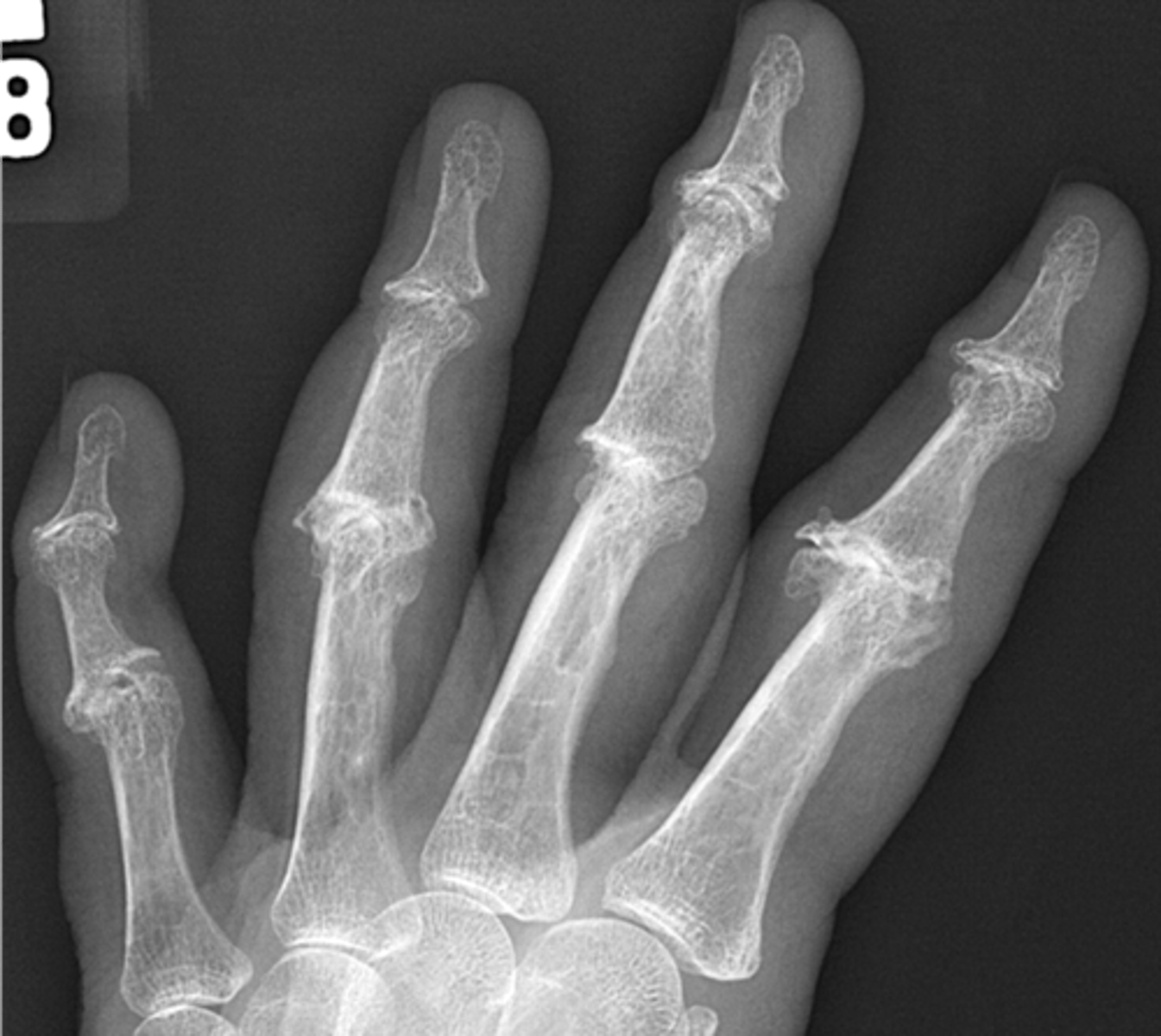 <p>Inflammation of the bone and joint</p>