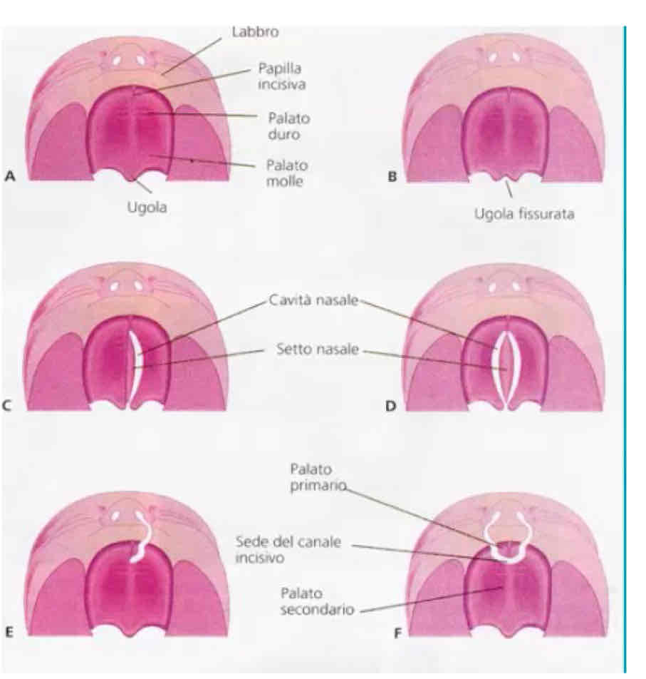 <p>Si basano su coordinazioni temporali delle strutture che mandano gradienti morfogeni e sono frequenti.</p><ul><li><p>Ugula bifida, processi palatini non fusi correttamente</p></li><li><p>Schisi palatale, mancata fusione dorsale più grave</p></li><li><p>Stafiloschisi, se scisso è il palato morbido</p></li><li><p>Stafilo uranoschisi, se coinvolge anche le strutture più ventrali</p></li><li><p>Labiopalatoschisi, mancata saldatura strutture esterne splancncranio (sia tessuti molli che mesenchimali profonde, quindi anche mascella)</p></li><li><p>Labioschisi, mancata saldatura solo dei tessuti molli del labbro</p></li><li><p>Schisi bilaterale, associata a patologie genetiche come trisomie.</p></li></ul>