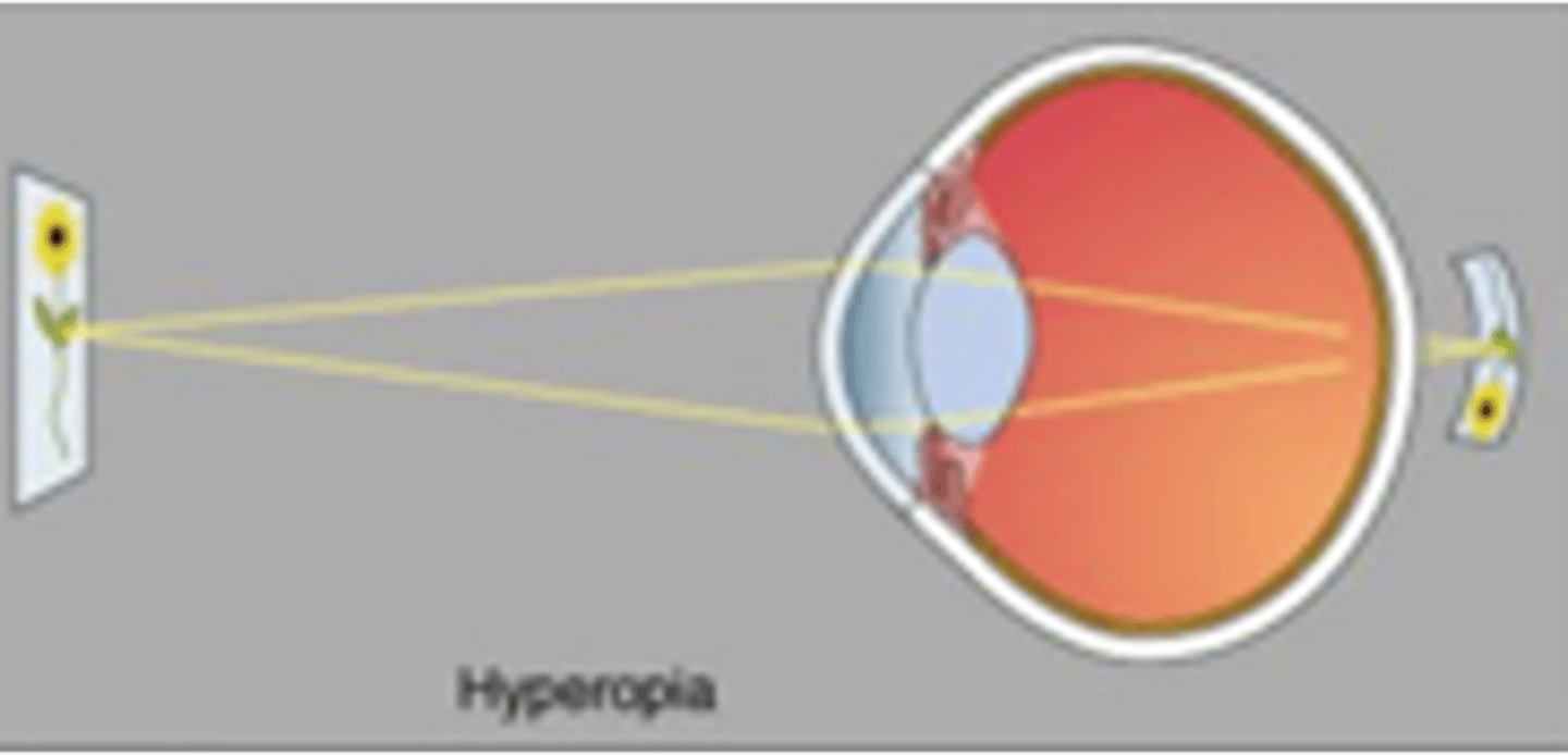 <p>Hyperopia is also referred to as farsightedness, describe this</p>