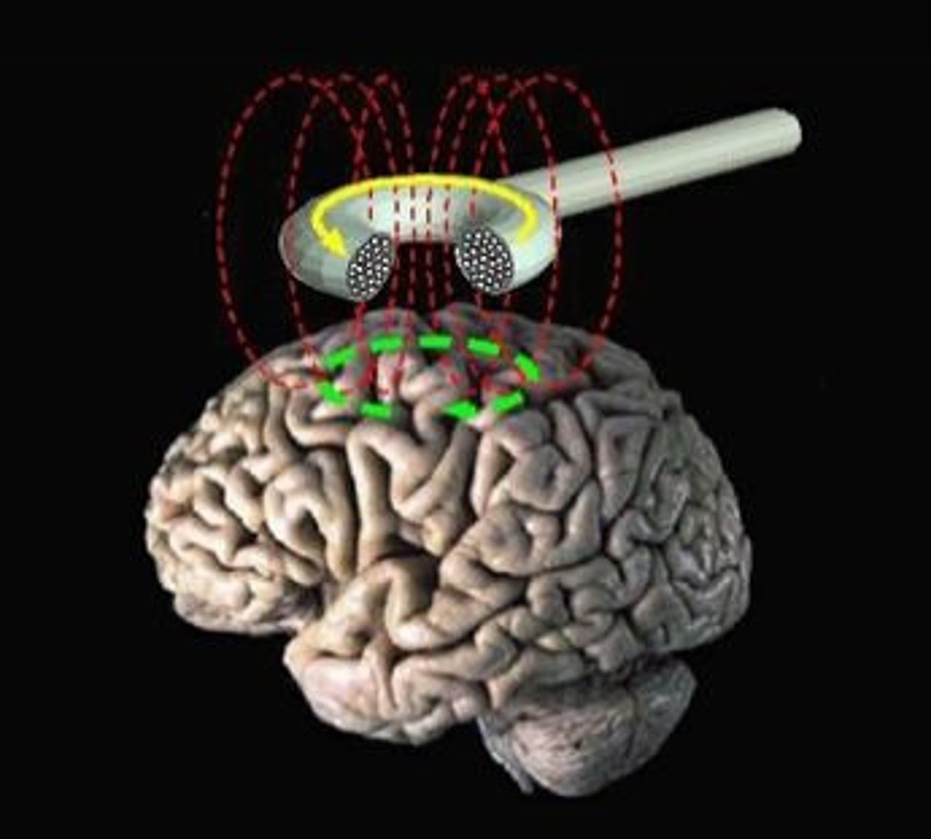 <p>transcranial magnetic stimulation (TMS)- non-invasive technique</p><p>- coiled (device) placed on top of scale + sends magnetic signals to brain -&gt; controls electrical activity of neurons</p><p>- magnetic stimulation to a portion of the scalp</p><p>- activates or inactivates neurons in a narrow area blow the magnet</p><p>- good temporal resolution</p><p>- temporary brain activity</p><p>limitations</p><p>- a little painful, discomfort</p><p>- only for brain cortex (most outer layer of the brain) -&gt; does not work on deeper areas of the brain (subcortical areas)</p><p>- difficult to target very specific areas of then brain (poor spatial resolution)</p><p>- transient cognitive changes (temporary, still a safe technique to use)</p>