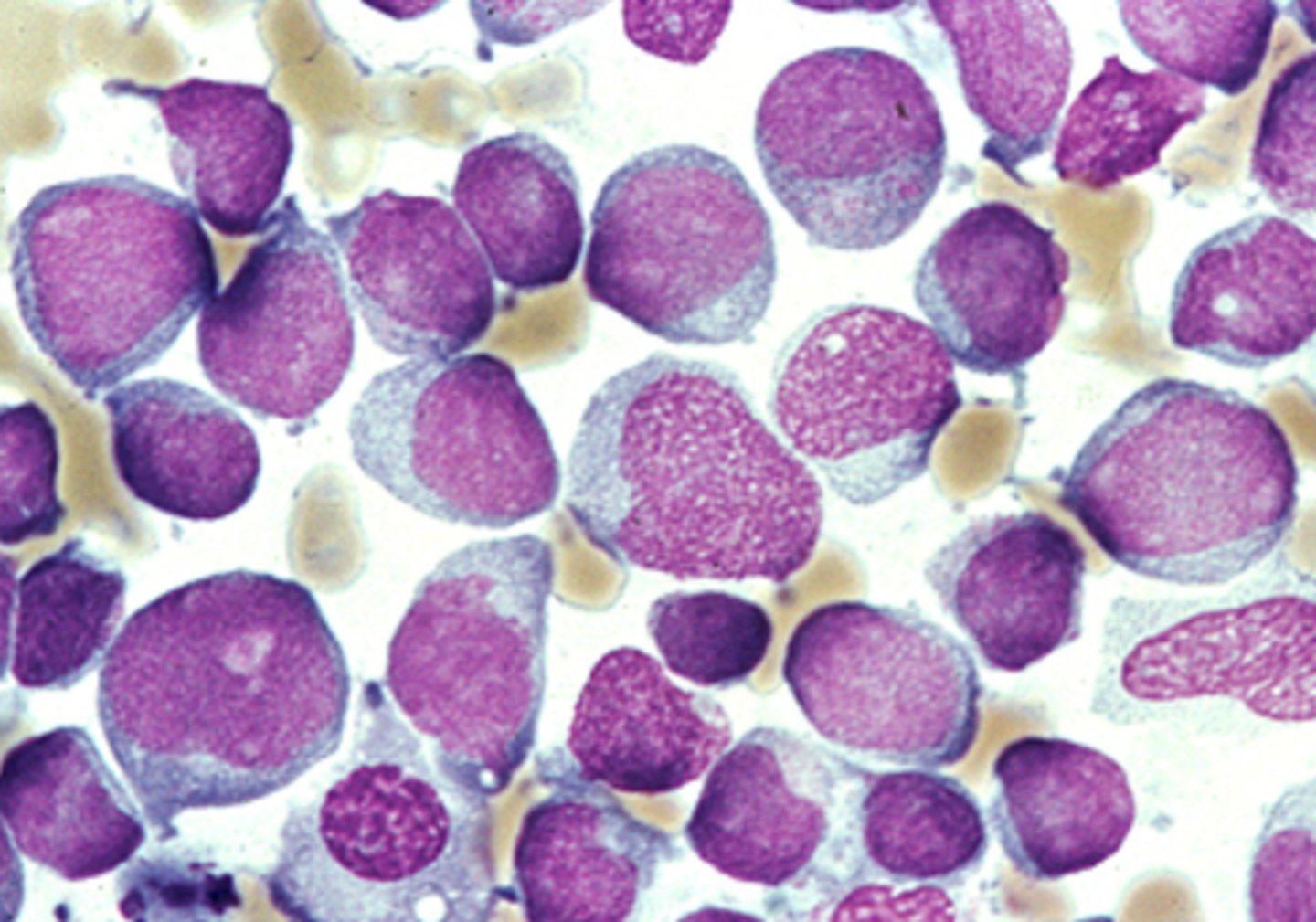 <p>bone marrow aspirate</p><p>-blasts are large, moderate amount of grayish blue cytoplasm, no distinct nucleoli</p>