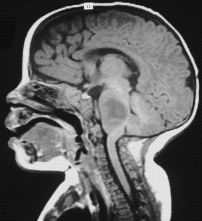 <ul><li><p>Are <span style="font-family: Lato, sans-serif">enmeshed with the pons (portion of the brainstem) and are unresectable. </span></p></li><li><p><span style="font-family: Lato, sans-serif">Radiation and chemotherapy have little or no effect. </span></p></li><li><p><span style="font-family: Lato, sans-serif">The survival rate is < 5% and is measured in months from the time of diagnosis.</span></p></li></ul><p></p>