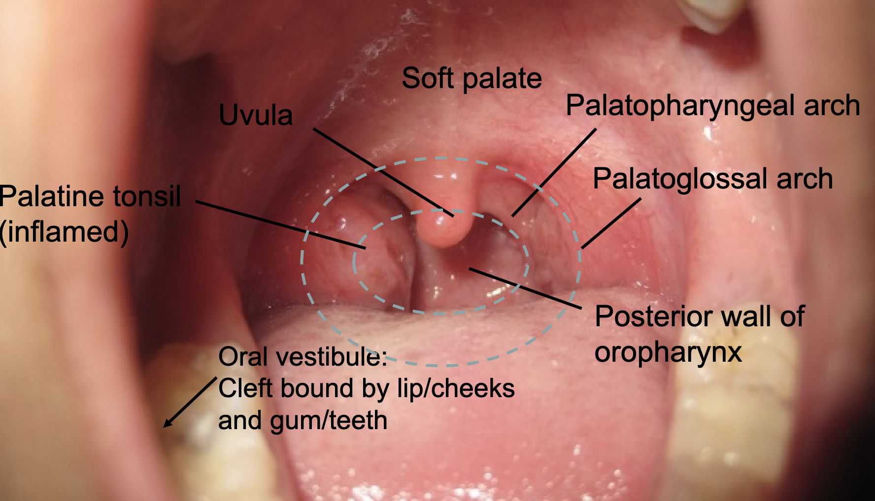 <p>palatoglossal arch <br>palatopharyngeal arch<br>soft palate/uvula<br>tonsillar fossa w/ palatine tonsils</p>