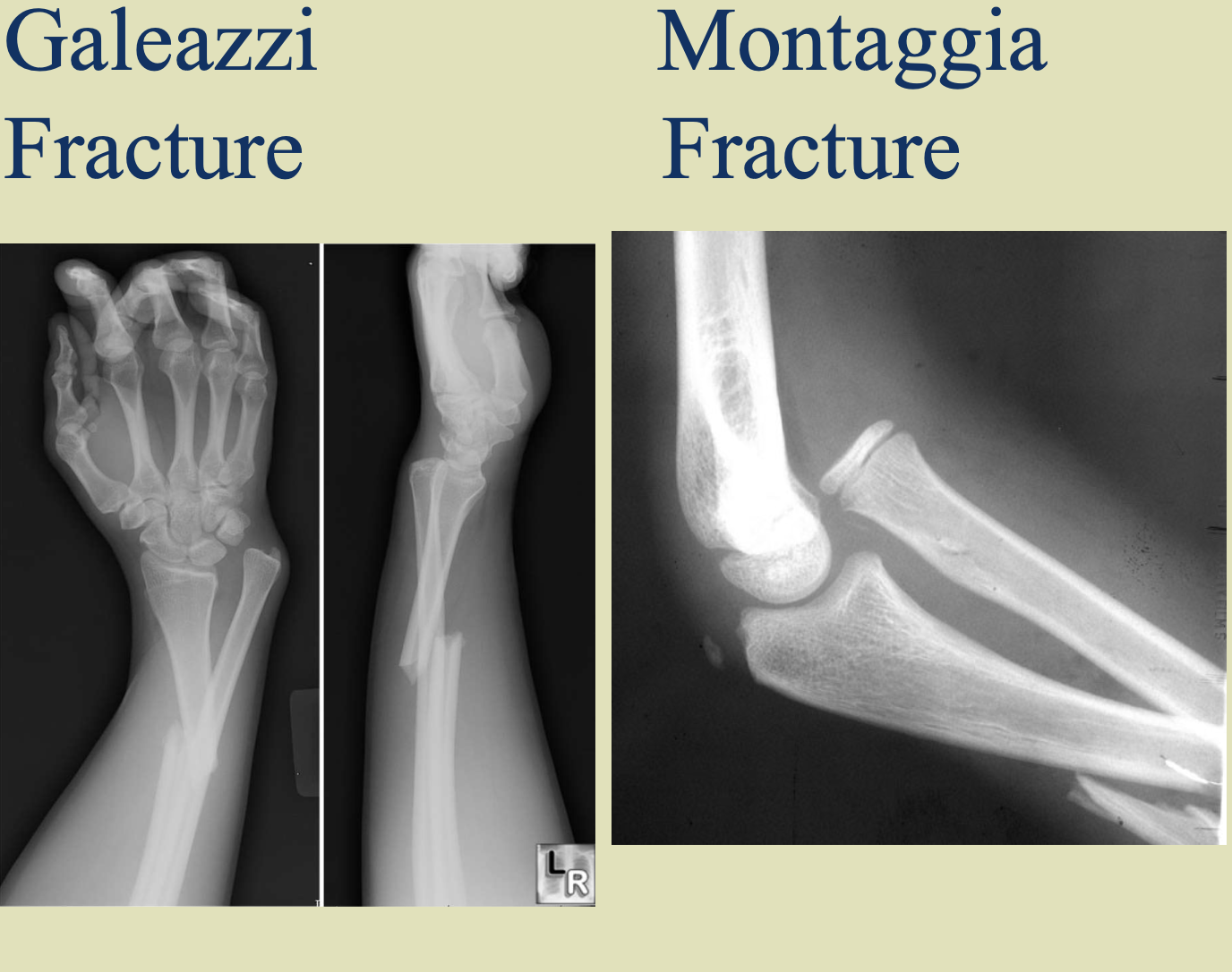 <p>distal humerus - usually high impact injury</p><p>olecranon - fall on posterior elbow</p><p>radial head</p><p>monteggia - ulna fx with radial head dislocation at the elbow</p><p>galeozzi - radius fx with ulna dislocation at the wrist</p>