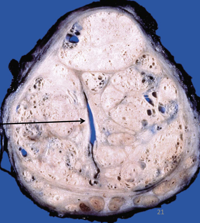 <p>What pathology is indicated by this image?</p>