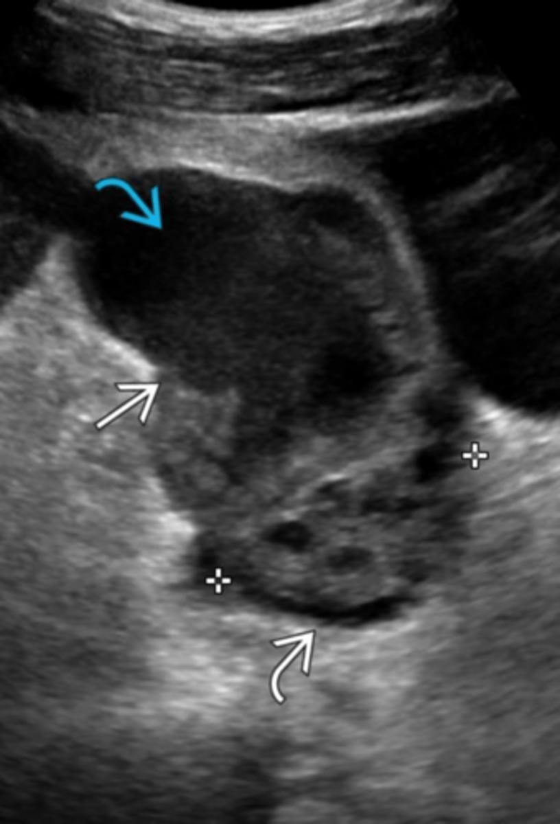 <p>An inflammatory mass involving the fallopian tube, ovary, and occasionally adjacent pelvic organs.</p>