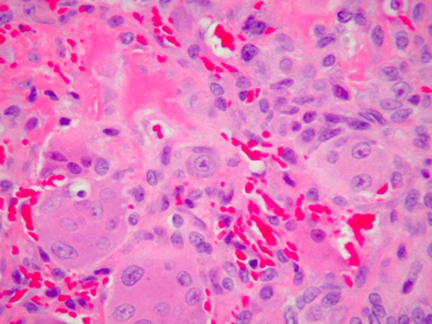 <p>Multinucleated giant cells with up to several dozen nuclei, hemorrhage and hemosiderin is associated with what pathology?</p>