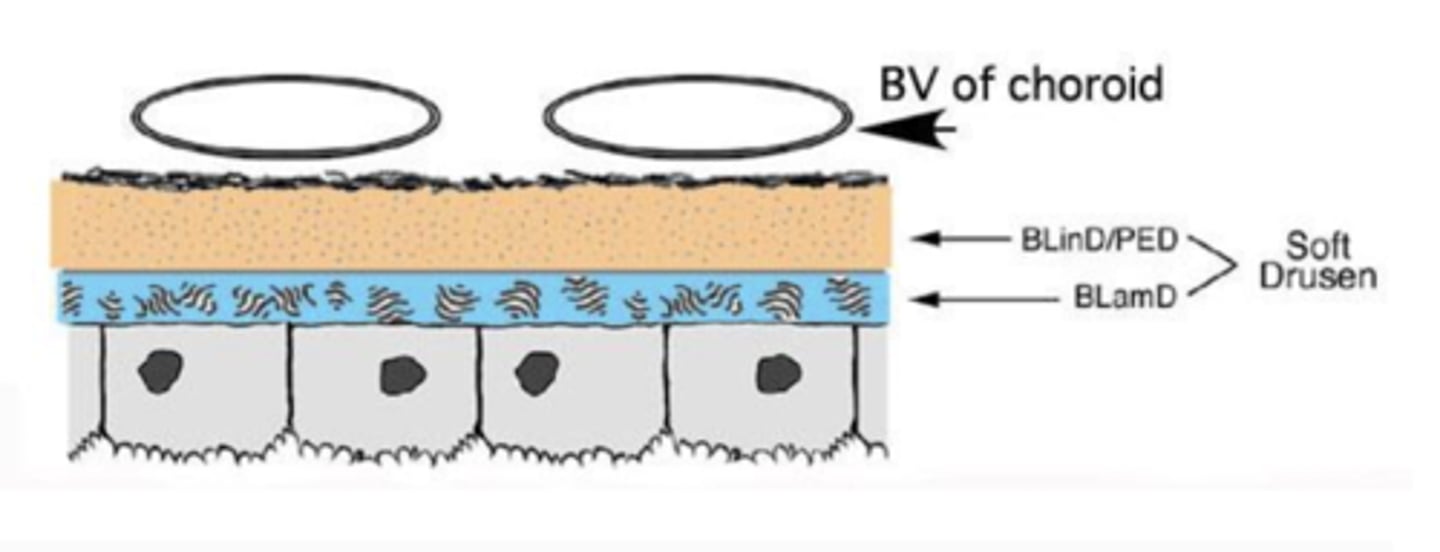 <p>between RPE and Bruch's membrane</p>