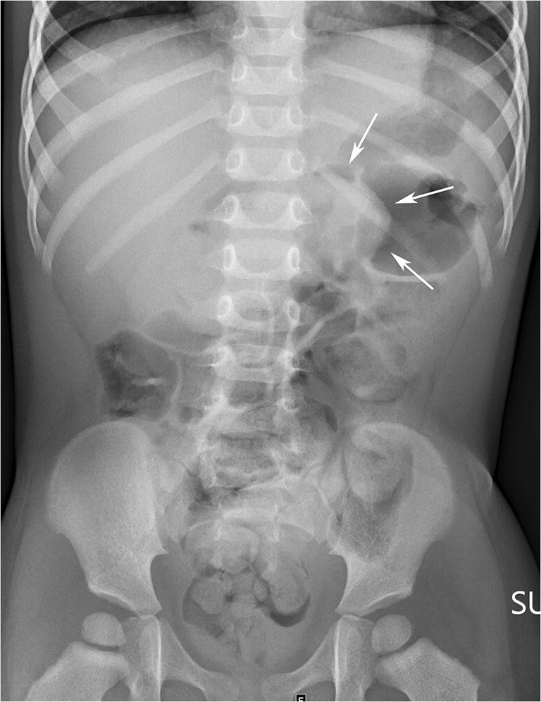 <p>What pathology is shown here?</p>